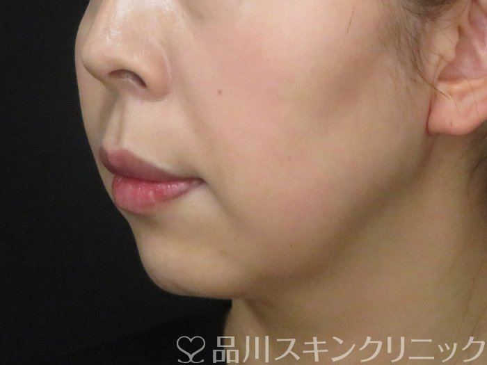 症例NO.69827のBEFORE写真
