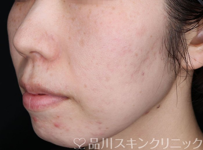 症例NO.69380のBEFORE写真