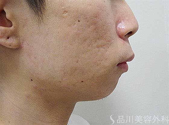 症例NO.53032のBEFORE写真