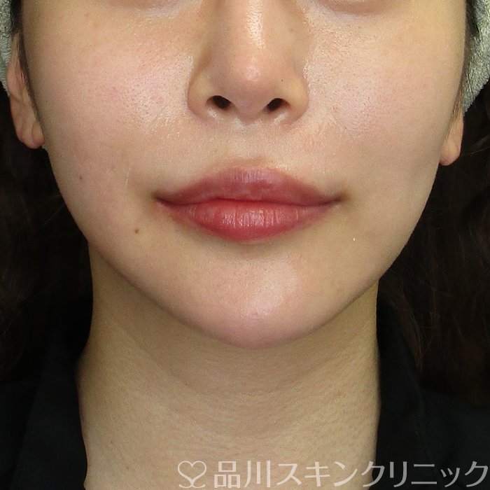 症例NO.74811のBEFORE写真