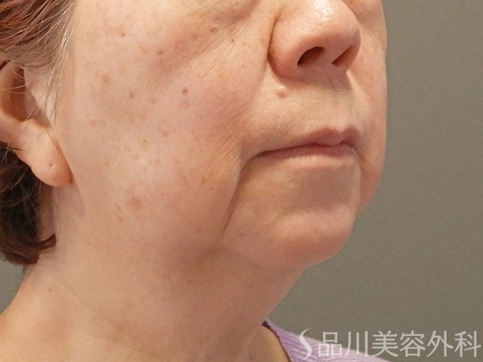 症例NO.70442のBEFORE写真