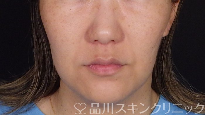 症例NO.72885のBEFORE写真