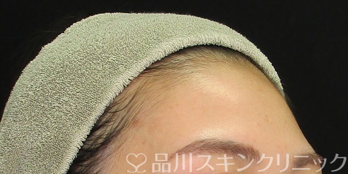 症例NO.67994のBEFORE写真