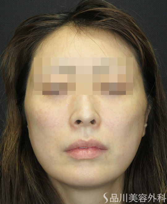 症例NO.72122のAFTER写真