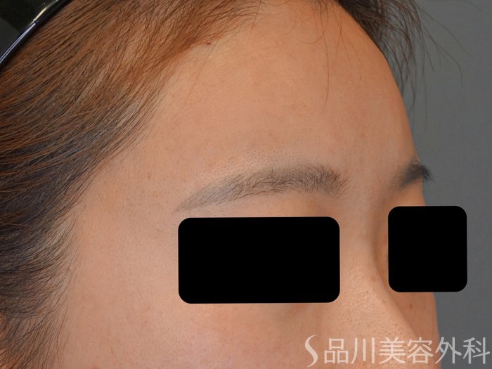 症例NO.73453のAFTER写真