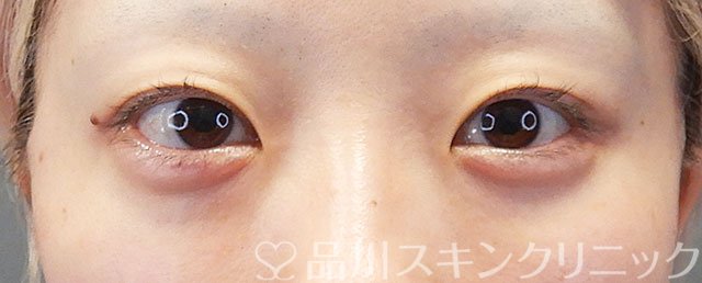 症例NO.72453のAFTER写真