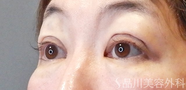 症例NO.67657のAFTER写真