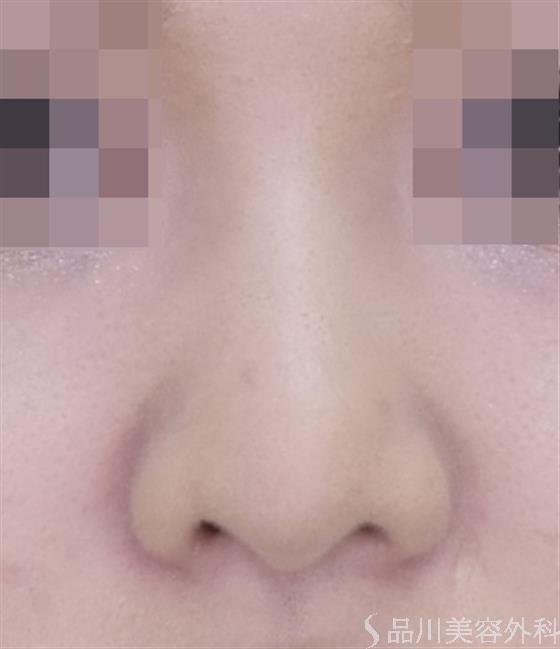 症例NO.49319のAFTER写真