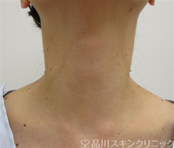 症例NO.41447のBEFORE写真