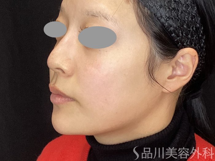 症例NO.72247のAFTER写真