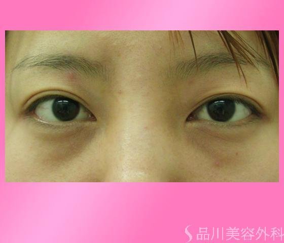 症例NO.2598のBEFORE写真