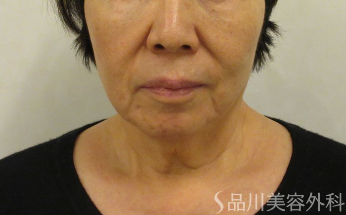 症例NO.73891のBEFORE写真