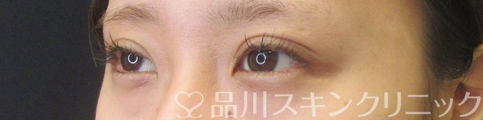 症例NO.68626のAFTER写真