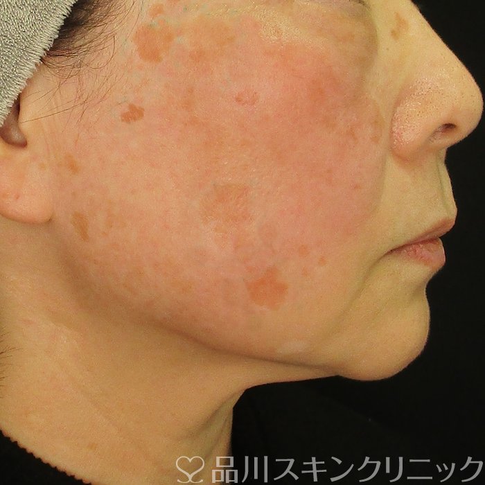 症例NO.74450のBEFORE写真
