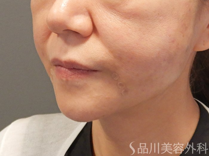 症例NO.71112のAFTER写真