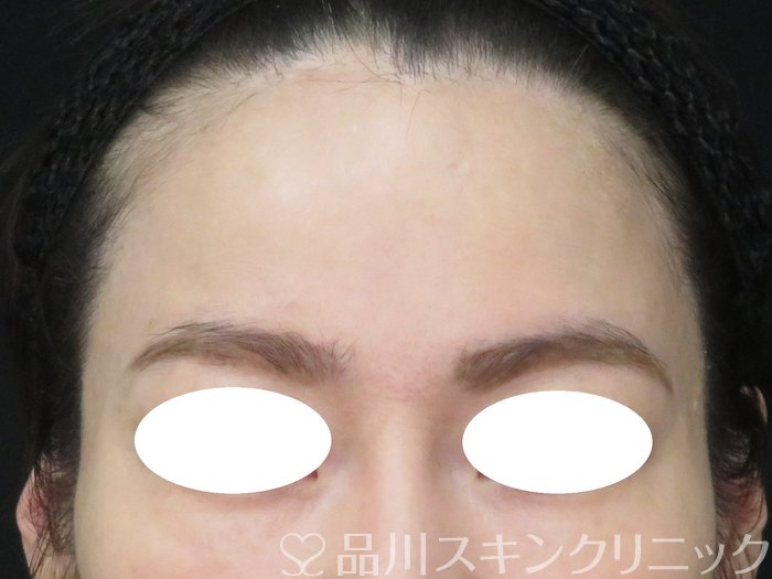 症例NO.70435のBEFORE写真