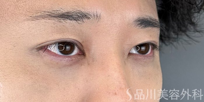 症例NO.72839のAFTER写真