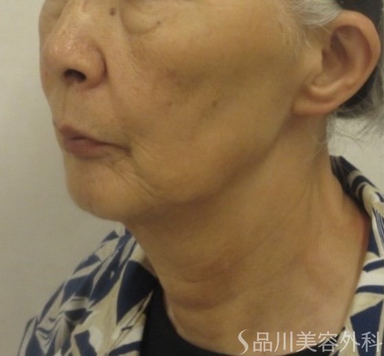 症例NO.74937のBEFORE写真