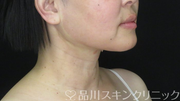 症例NO.71779のAFTER写真