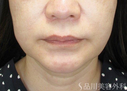 症例NO.69923のBEFORE写真