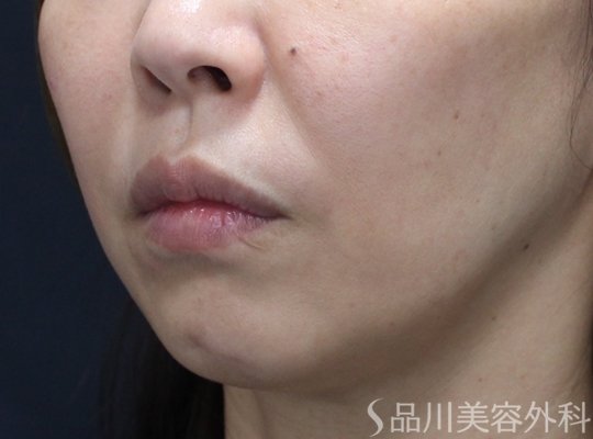 症例NO.74623のBEFORE写真