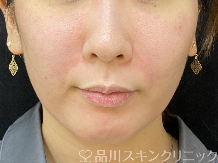症例NO.74034のAFTER写真
