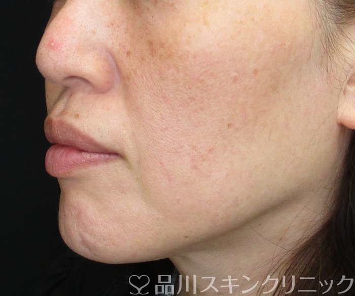 症例NO.74806のBEFORE写真