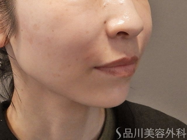 症例NO.74340のAFTER写真