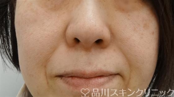 症例NO.32202のBEFORE写真