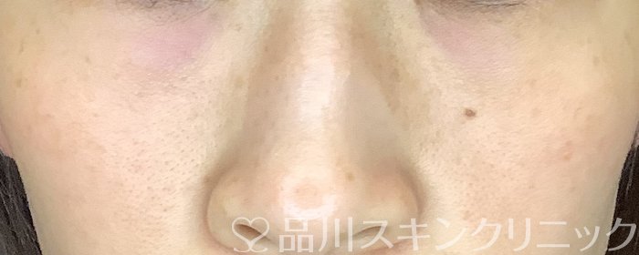 症例NO.73918のBEFORE写真