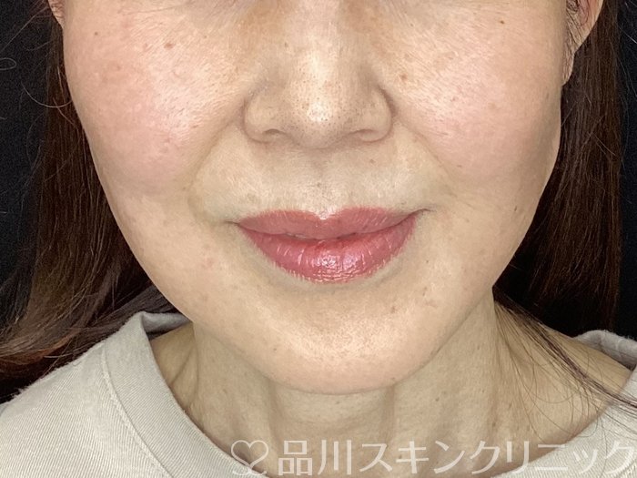 症例NO.72497のAFTER写真