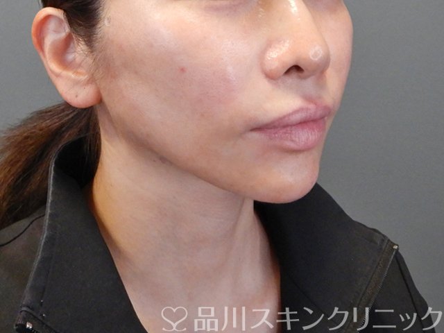 症例NO.68057のAFTER写真
