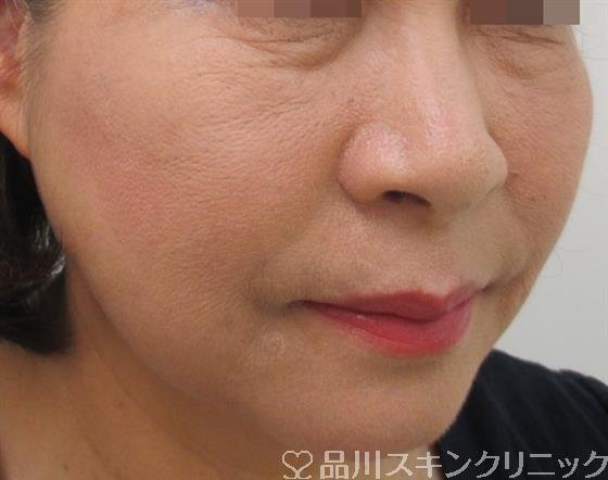 症例NO.26429のAFTER写真