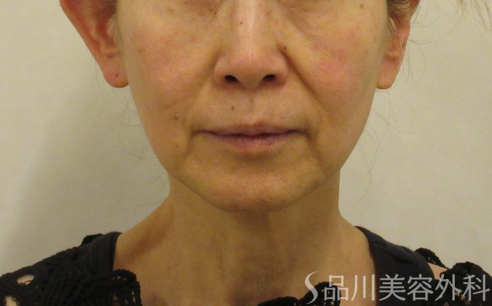 症例NO.73075のBEFORE写真