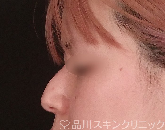 症例NO.69801のBEFORE写真