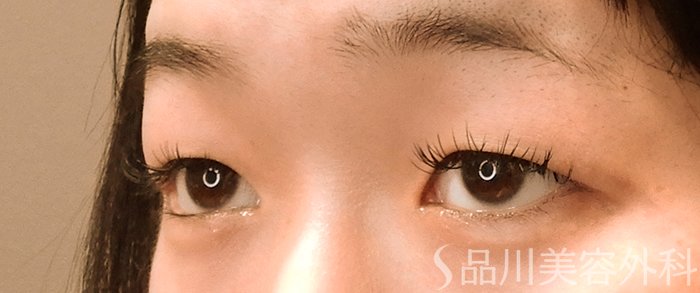 症例NO.70396のBEFORE写真