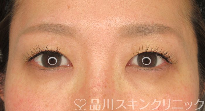 症例NO.69933のBEFORE写真