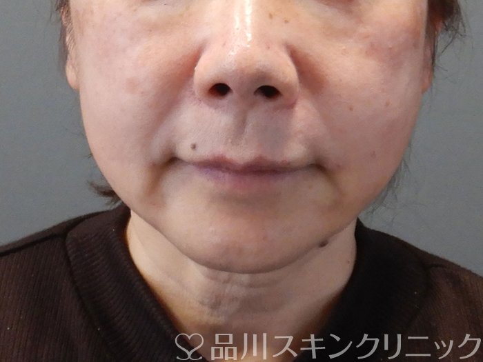 症例NO.73073のAFTER写真