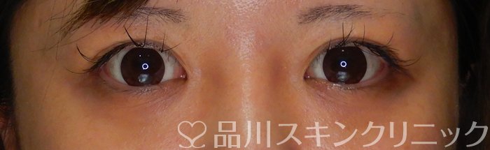 症例NO.64888のBEFORE写真