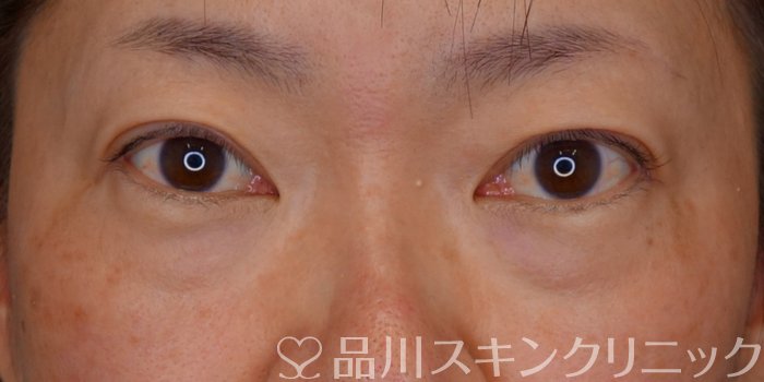 症例NO.73114のBEFORE写真