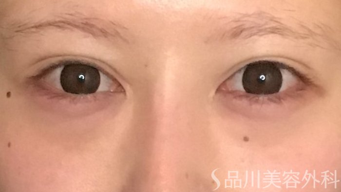 症例NO.65621のAFTER写真