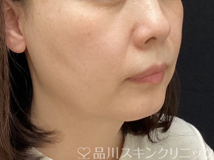 症例NO.69648のBEFORE写真