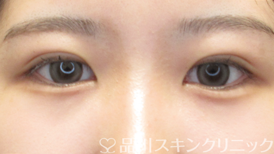 症例NO.69509のAFTER写真