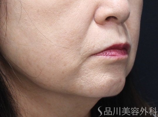 症例NO.74634のBEFORE写真