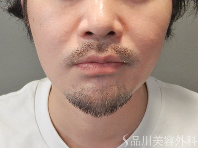 症例NO.74957のAFTER写真