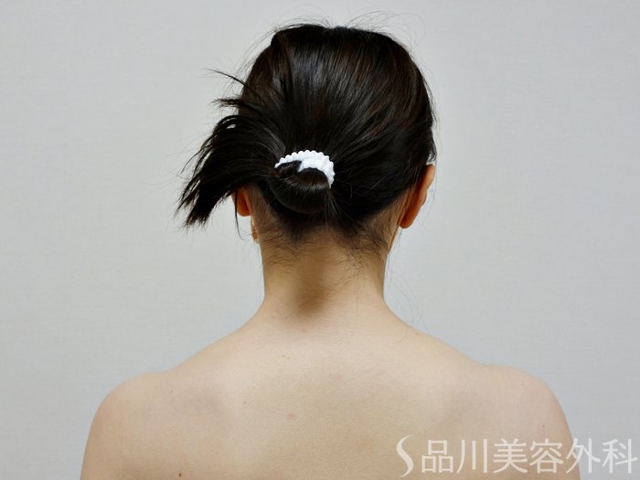 症例NO.73150のBEFORE写真