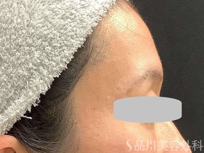 症例NO.67761のBEFORE写真
