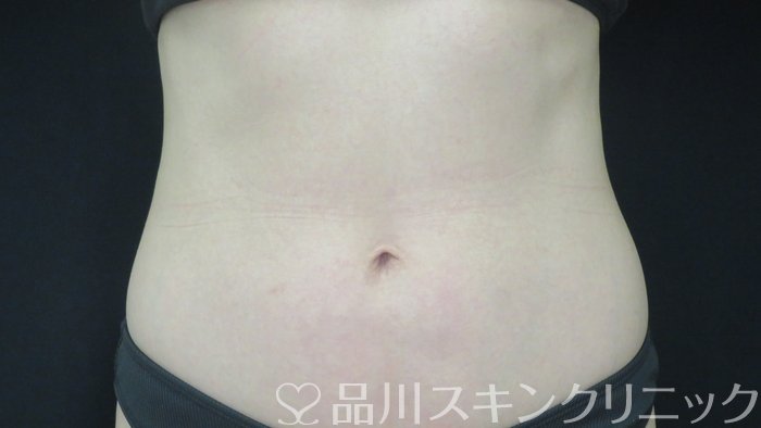 症例NO.71120のAFTER写真