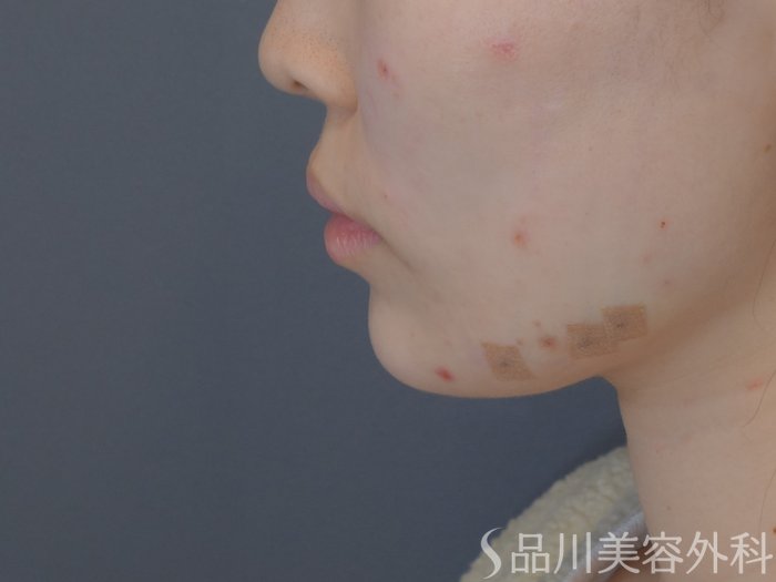 症例NO.72317のAFTER写真
