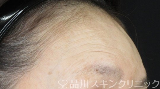 症例NO.69823のAFTER写真
